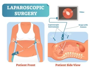Laparoscopy Testing and Treatment in Ahmedgarh, Punjab